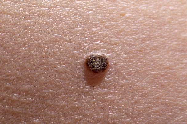 A melanoma kezdeti stádiuma - Fotó, kép