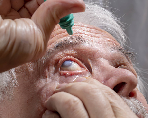 Un homme âgé enterre la médecine dans ses yeux
 - Photo, image