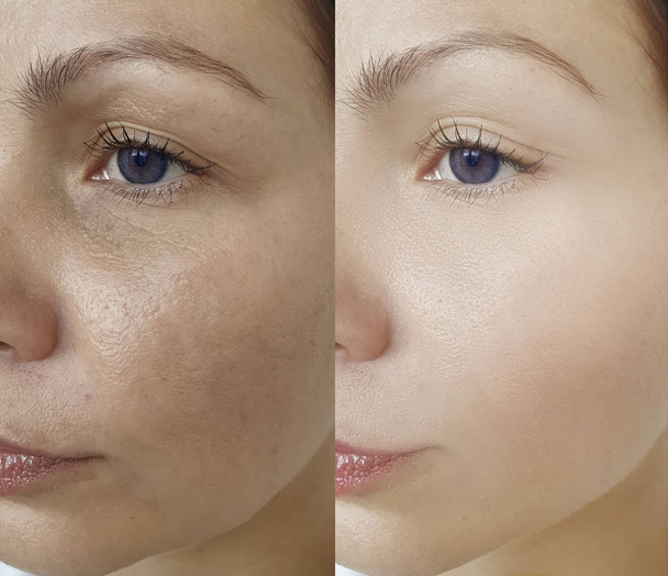 arrugas faciales de la mujer antes y después del tratamiento - Foto, imagen