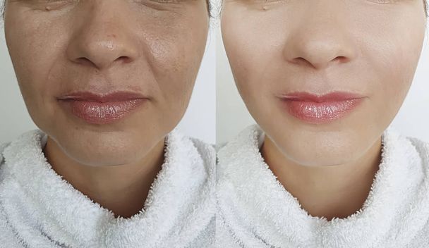 zmarszczki twarzy kobiety przed i po leczeniu - Zdjęcie, obraz