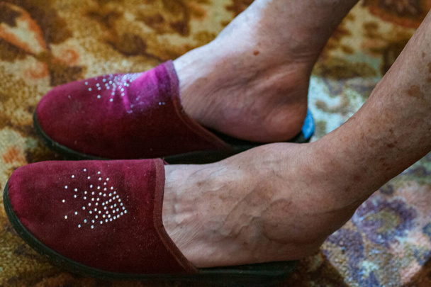 Nahaufnahme Füße eines an Lepra erkrankten alten Mannes mit einem Stock auf dem Boden - Foto, Bild