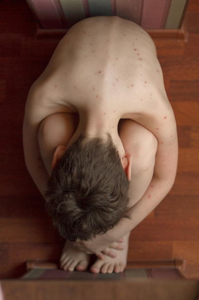 Garçon avec varicelle
 - Photo, image