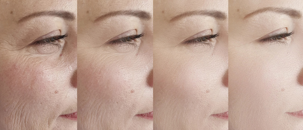 Falten im Gesicht der Frau vor und nach der Behandlung - Foto, Bild