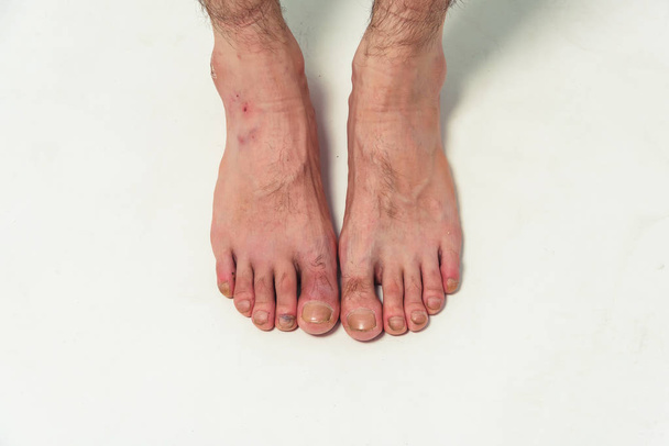 Male Nude legs close up. The feet of a man without shoes. Fungus of the toenails. Not well-groomed men's nails and feet - Photo, Image