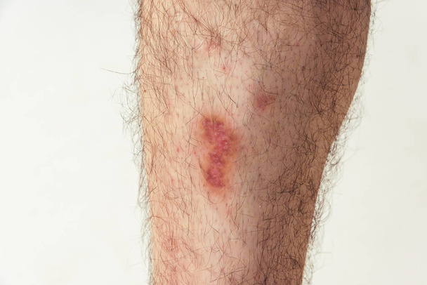 Τραυματισμός του δέρματος μετά από πτώση από μοτοσικλέτα στο πόδι ενός άνδρα. Δερματικές κακώσεις στο σώμα του ανθρώπου. Βλάβη και τραύμα στο λευκό δέρμα - Φωτογραφία, εικόνα