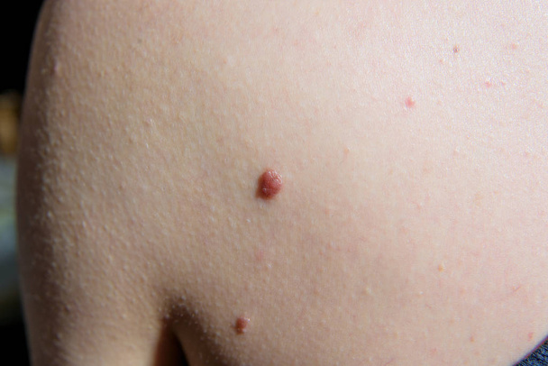 Μια μεγάλη ελιά στο μπράτσο. Καρκινοειδής ελιά στο σώμα ενός άντρα. Μολύβια και κηλίδες στο λευκό ανθρώπινο δέρμα. - Φωτογραφία, εικόνα