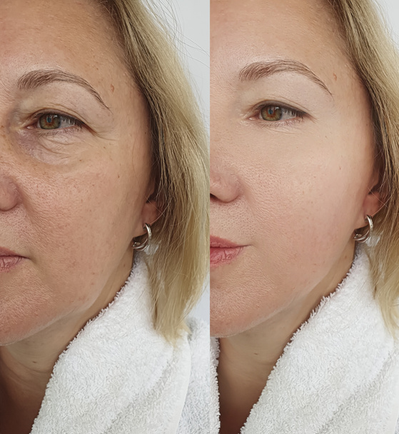 vrouw gezicht rimpels voor en na de behandeling - Foto, afbeelding