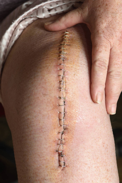 после операции по протезированию колена
 - Фото, изображение