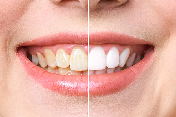 ホワイトニング前と後の女性の歯。白地の上だ。歯科医院の患者だ。画像は口腔ケア歯科、胃学を象徴しています - 写真・画像