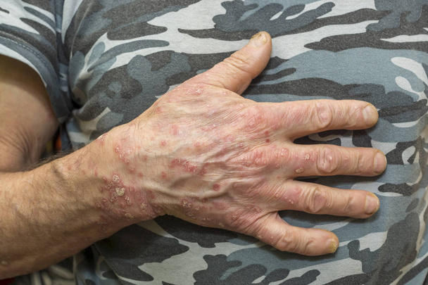 Pelle di mano di uomo colpita da una malattia dermatologica - psoriasi
 - Foto, immagini