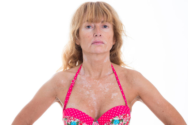 retrato de mujer adulta con marcas de vitiligo
 - Foto, Imagen