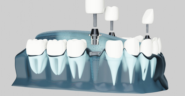 Bestandteil von Zahnimplantaten. blaue Farbe transparent. 3D-Abbildungen - Foto, Bild