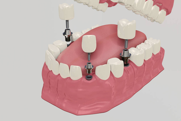 Procedure voor tandheelkundige implantaten. Medisch nauwkeurige 3D illustratie kunstgebit concept. - Foto, afbeelding