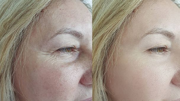 idős nő ráncai arcát kezelés előtt és után - Fotó, kép