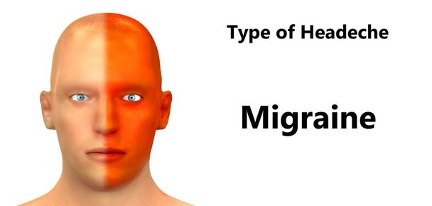 Maux de tête humains Types d'anatomie (Migraine). 3D - Illustration
 - Photo, image