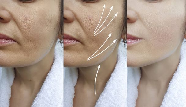 mulher rugas rosto antes e após o tratamento seta, elevação de linha
 - Foto, Imagem