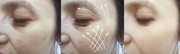 治療前と治療後の女性のしわの顔矢印 - 写真・画像