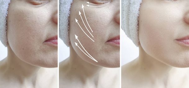 žena vrásky tvář před a po ošetření šipka - Fotografie, Obrázek
