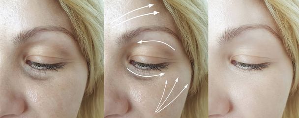 vrouw rimpels gezicht voor en na behandeling pijl - Foto, afbeelding