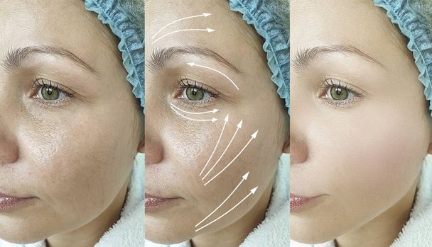 γυναίκα ρυτίδες πρόσωπο πριν και μετά τη θεραπεία βέλος - Φωτογραφία, εικόνα