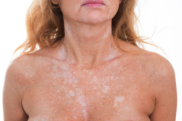 Detail der Vitiligo Flecken auf der Haut - Foto, Bild