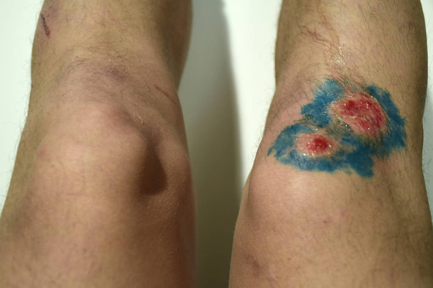 Bruise injury on young man knee. Close up image of male person sitting and examining wounded leg with fester. Wound infection concept. Wound in the male leg. - Photo, Image