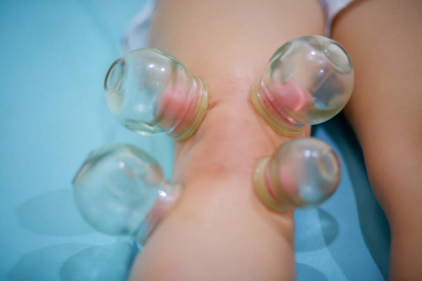 Chinese medicine science is a method of treatment using Cupping  - Photo, Image