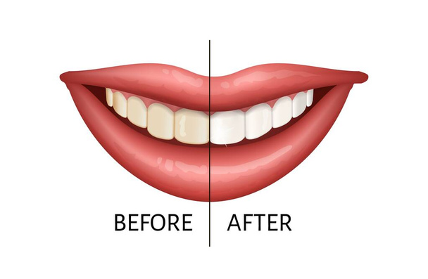 Zęby przed i po procesie wybielania. Koncepcja medyczna. Ilustracja wektora izolowana na białym tle. - Wektor, obraz