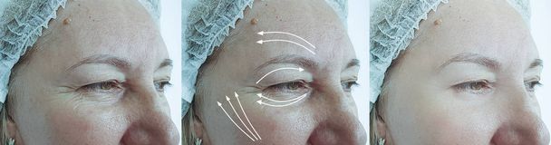 ältere Frau Gesicht Falten vor und nach Behandlung Pfeil - Foto, Bild