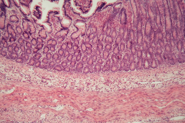 Microscope photo of a large intestine section with inflammation (Colitis). - Photo, Image