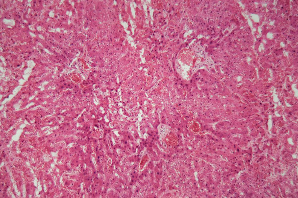 Tejido hepático con amiloidosis bajo un microscopio
. - Foto, Imagen