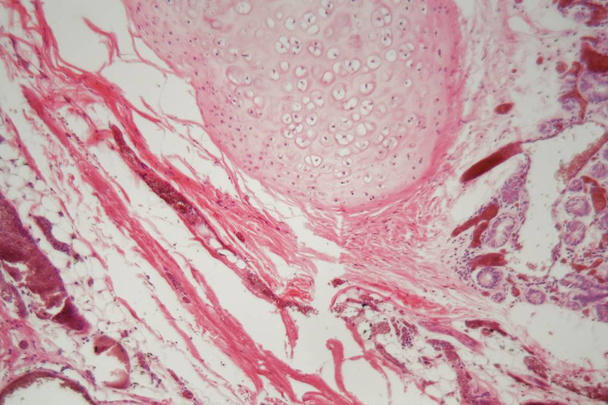 Tissu pulmonaire humain avec embolie pulmonaire au microscope
. - Photo, image