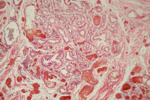 Tissu pulmonaire humain avec embolie pulmonaire au microscope
. - Photo, image
