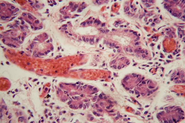 Lidská plicní tkáň s plicní embolií pod mikroskopem. - Fotografie, Obrázek