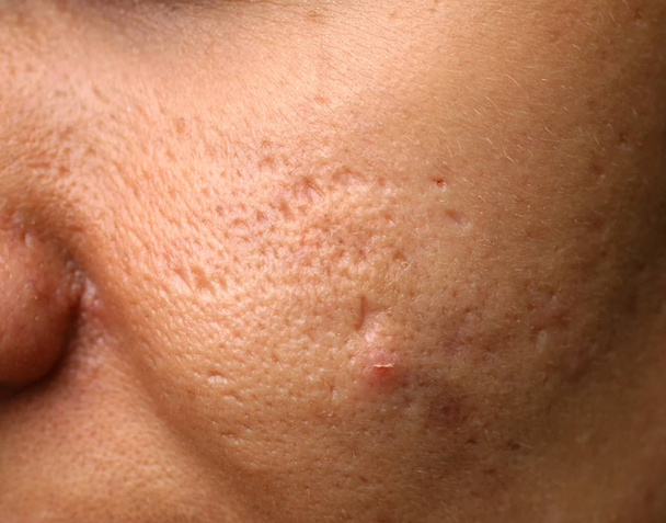 Inflamed skin on the face. Acne. Pimples on the skin. Scars and peeling. - Photo, Image