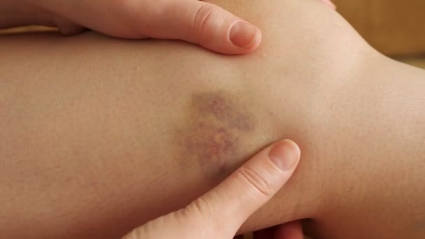 Mujer examina y siente el moretón en su pierna
 - Metraje, vídeo