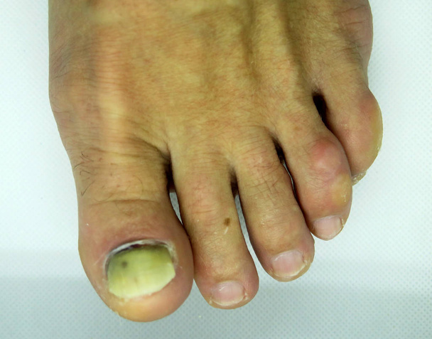 Damaged toenail. The thumb on the man's leg. Ugly, injured and broken nail on the foot. - Photo, Image