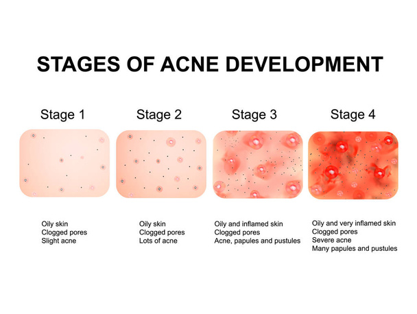 Stadia van de ontwikkeling van acne. Ontstoken huid met littekens, acne en puistjes. De textuur van ontstoken huid, en acne en puistjes. Infographics. Vector illustratie. - Vector, afbeelding
