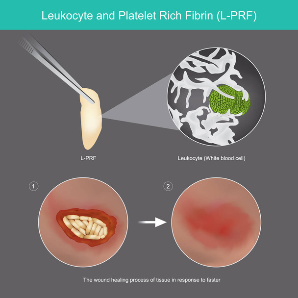 Leukocyt i płytki krwi bogate w fibrynę. Ilustracja gojenie się rany p - Wektor, obraz