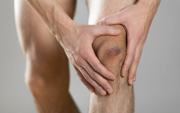 El moretón en su rodilla. Dolor de rodilla. El hombre sostiene su pierna. Cierre
  - Foto, Imagen