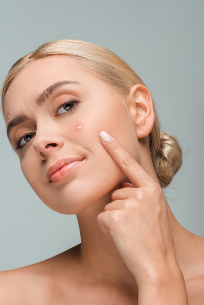 displeased girl pointing with finger at face with acne isolated on grey  - Foto, Imagem
