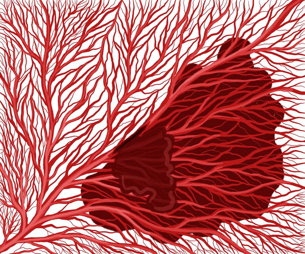 ilustração de acidente vascular cerebral, ramificação da rede capilar vascular
 - Foto, Imagem