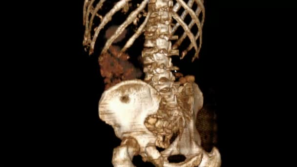 Luuranko skannaus 3D MRI Scan. CT skannaa lonkan ja selkärangan alue 3D tietokoneen näytössä
 - Materiaali, video