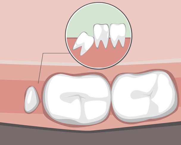 A wisdom tooth grows incorrectly and interferes with molars as a - Vector, Image