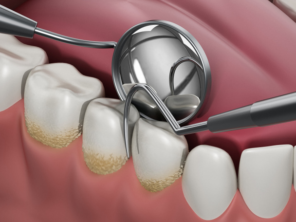 3D illustration showing dentist tools and dental plaque on model. 3D illustration - Photo, Image
