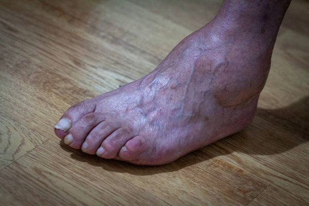 primer plano pies de edad un sufrimiento de la lepra
 - Foto, imagen