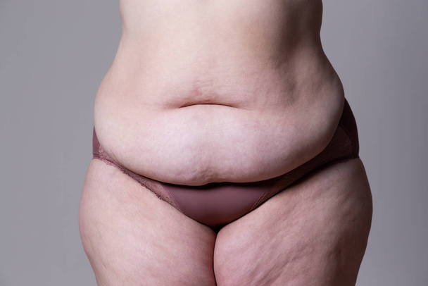 Tummy tuck, flabby skin on a fat belly, plastic surgery concept - Fotó, kép