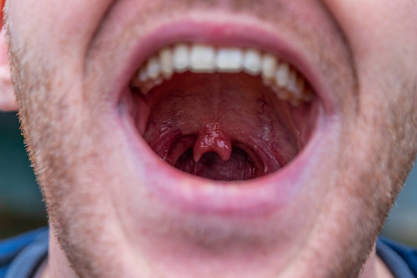 Mies, jolla on leveä suu ja outo poikkeavuus kaksinkertaisen uvulan muodossa kurkussa, osoittaa harvoin poikkeavuutta ja hauskaa anatomiaa urospuolisessa uvulassa ja lääketieteellisessä anatomiassa.
 - Valokuva, kuva