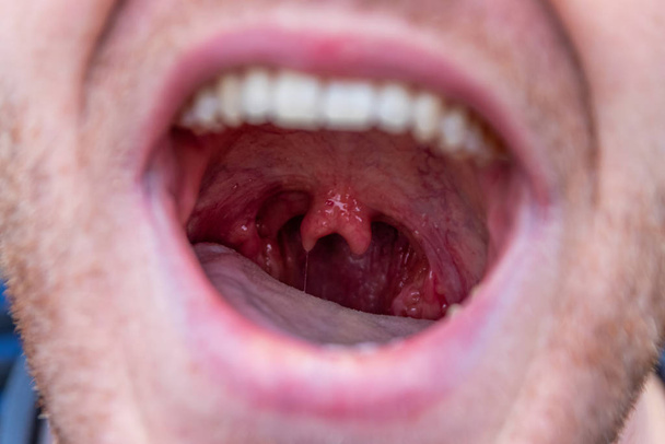 Мужчина с широко раскрытым ртом и странной аномалией в виде двойной увулы в горле показывает редко аномалию и смешную анатомию в мужской увуле и медицинскую анатомическую значимость
 - Фото, изображение