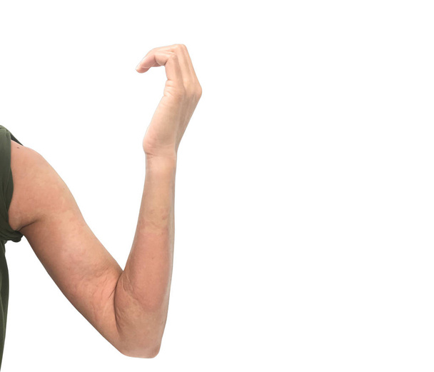 Алергічна реакція шкіри на жіночу кропив'янку на шкіру руки
-  - Фото, зображення